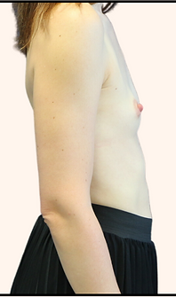 Before silicone implant Dr Vivien Moris