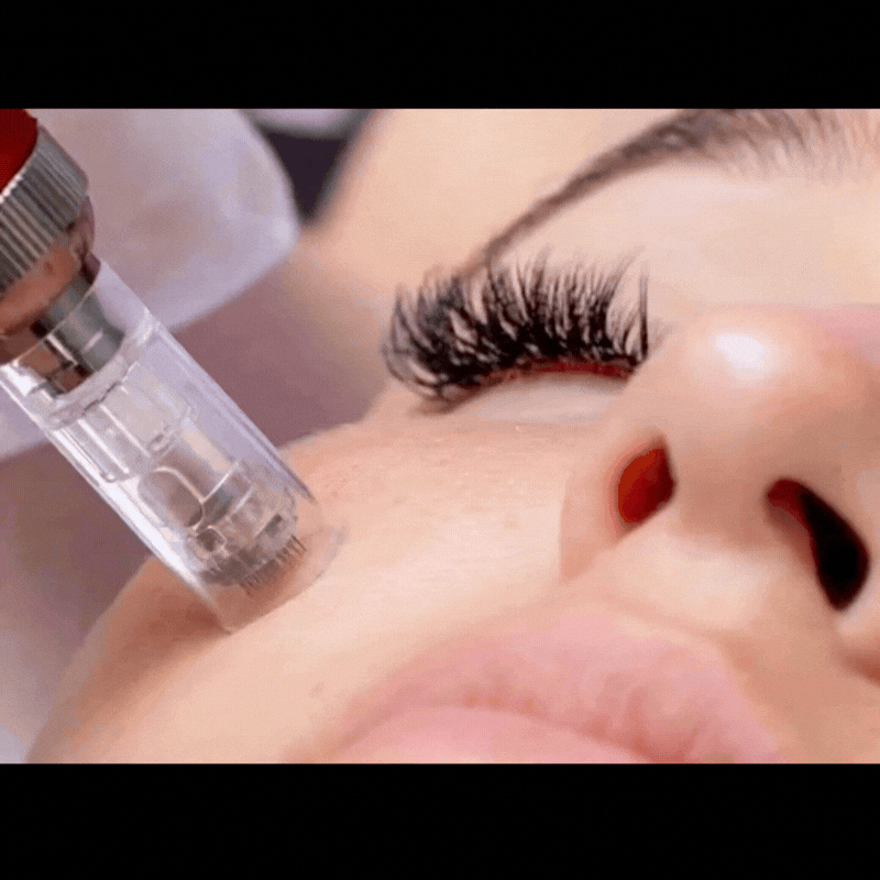 microneedling.gif