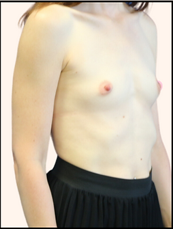 Before silicone implant Dr Vivien Moris