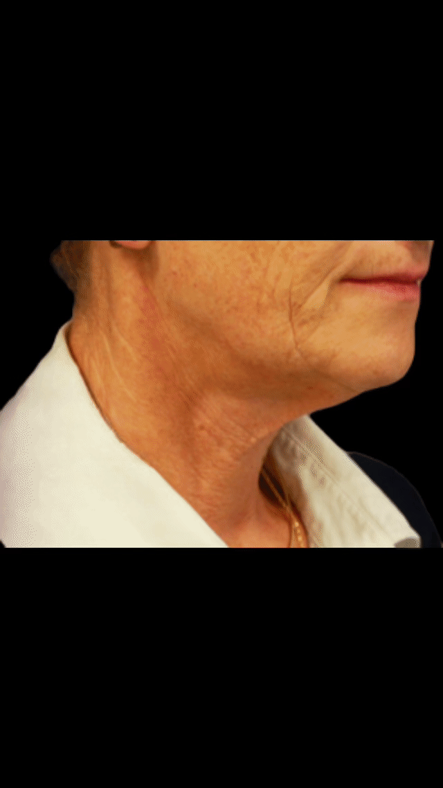 Neck Lift Dr Vivien MORIS - Dubai