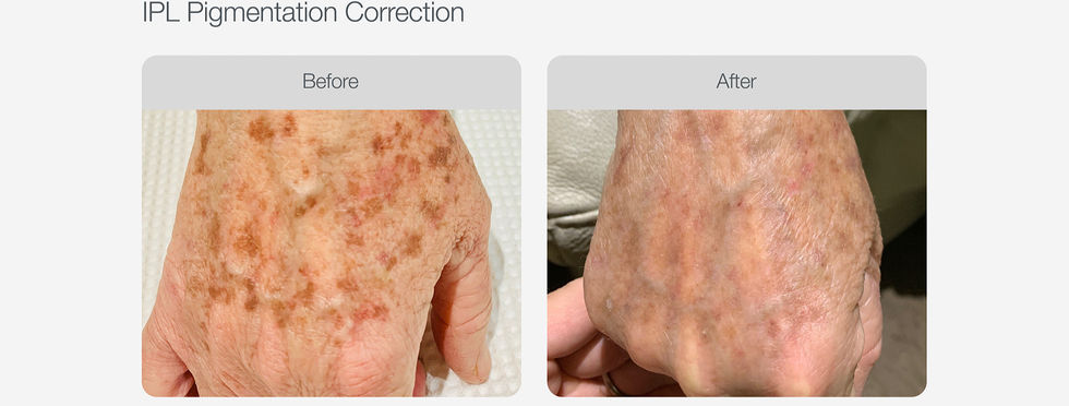 IPL_Pigmentation_Correction_Before_After_10.jpg