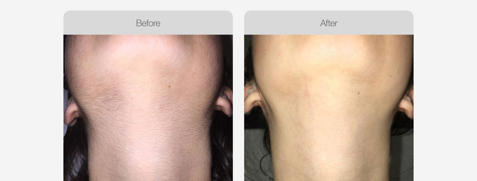 IPL_Hair_Removal_Before_After_02.jpg