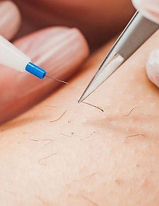 Electrolysis by Svitlana