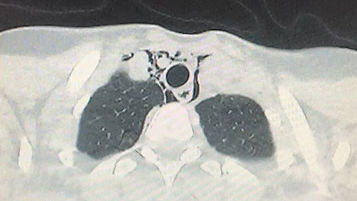 INSUFFICIENZA RESPIRATORIA ACUTA IN GIOVANE DONNA: UN CASO DI PNEUMOMEDIASTINO SPONTANEO