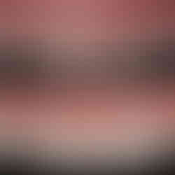 before and after ceramic veneers, hollywood smile