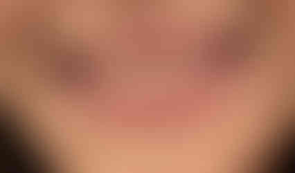 before and after veneers