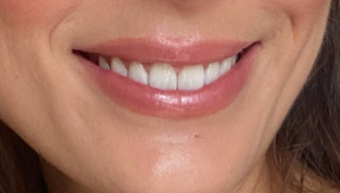 before and after veneers