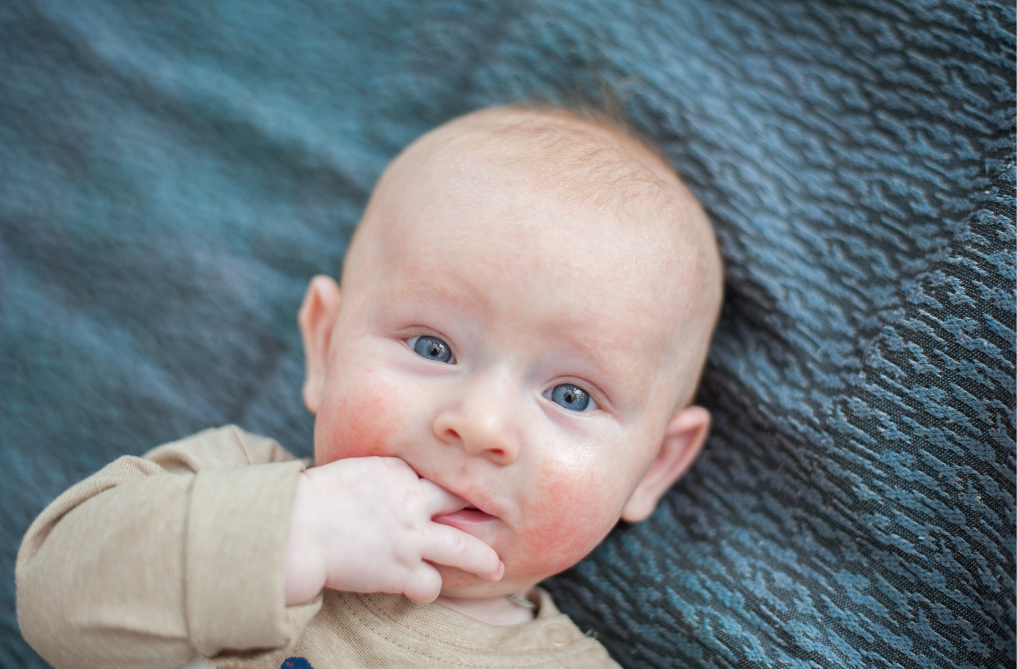 Tratamento e Gestão do Eczema, image size:2000x1316