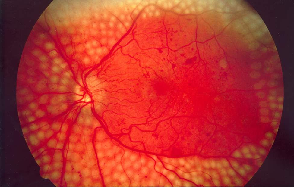 Panretinal photocoagulation image