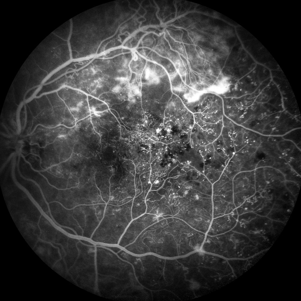 neovascular diabetic retinopathy angiogram