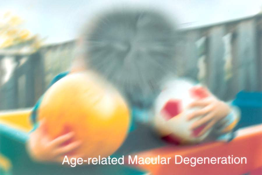 macular degeneration vision loss