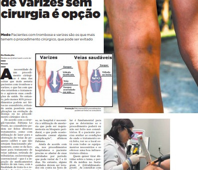 Tratamento de varizes sem internação é opção para quem quer evitar cirurgias