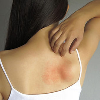 Health allergy skin care problem_ Closeup young woman scratching her itchy back with aller