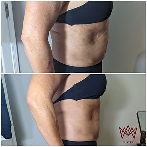 body contouring