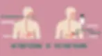 NG Tube v PEG Tube