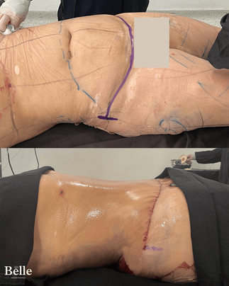 Resultado Abdominoplastia Bogotá