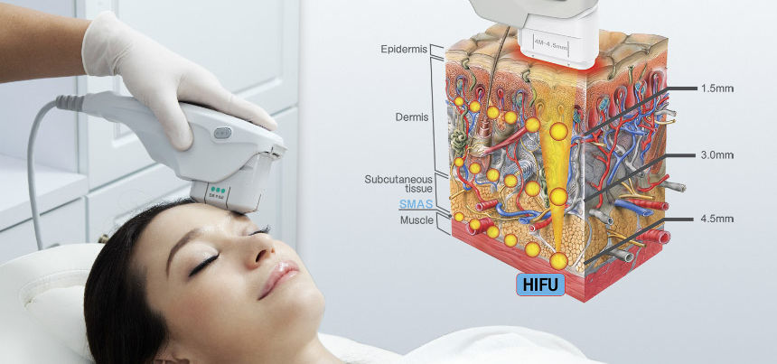 HIFU device_ Secret Beauty Lily_ Perth.jpeg
