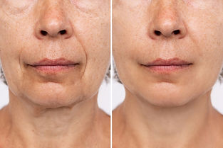 antes-e-depois-do-bioestimulador-de-colageno.jpg