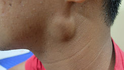 Preauricular swelling with differential diagnosis of Parotid swelling or lymphadenopathy..