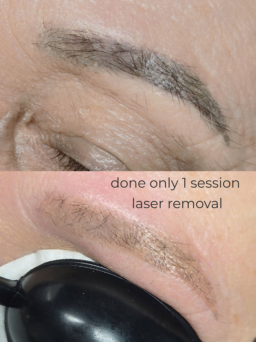 pico laser removal