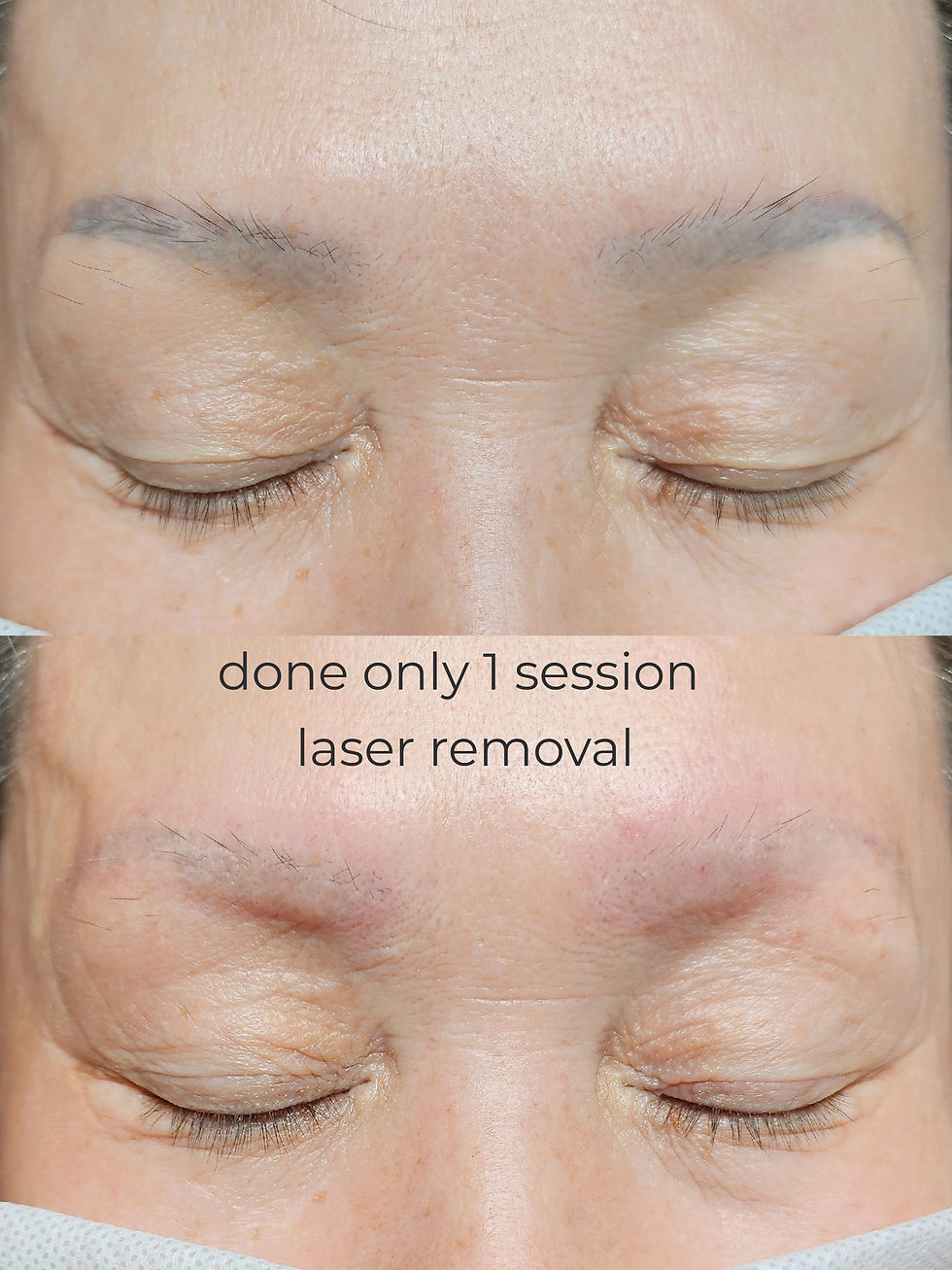 pico laser removal