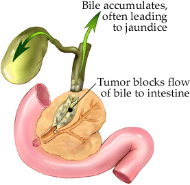 Bile Duct Cancer