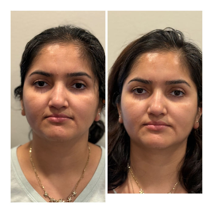 Buccal Massage Before and After | Revive