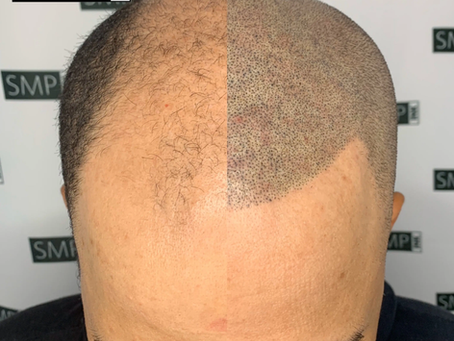 Premium non-surgical hair line tattoo Singapore results at The Scalp Studio