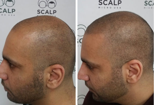 Sides & Nape Treatemtn result by customer from The Scalp Studio