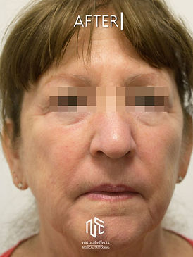 Plasma Non Surgical Full Facelift Skin Tightening