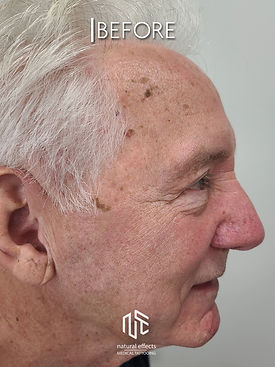 Age Spot Moles Skin Tag Removal Non Surgical No Downtime No Scars