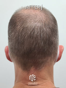 Soft Natural Scalp Micropigmentation Scar Camouflage Hair Loss Treatment Medical Tattoo Women Men
