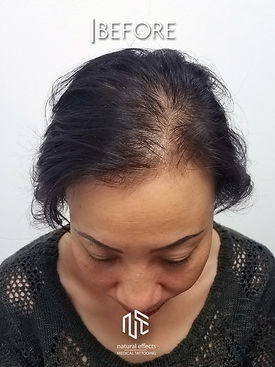 Soft Natural Scalp Micropigmentation Hair Loss Treatment Medical Tattoo Women