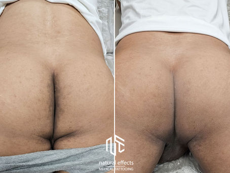 Transforming Confidence with Medical Tattooing on Hyperpigmentation Skin