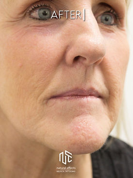 Plasma Non Surgical Jowl Lift Skin Tightening