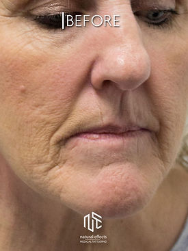Plasma skin tightening to reduce excessive wrinkles. Non surgical face lift
