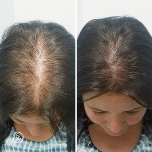 Our Son Says His Hair Loss Has Ruined His Life