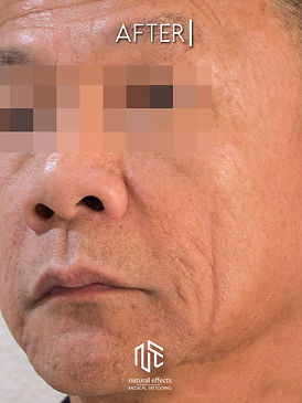 Acne scar reduction using plasma to reduce the appearance of deep subdermal acne scars