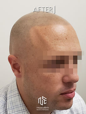 Soft Natural Scalp Micropigmentation Hair Medical Tattoo