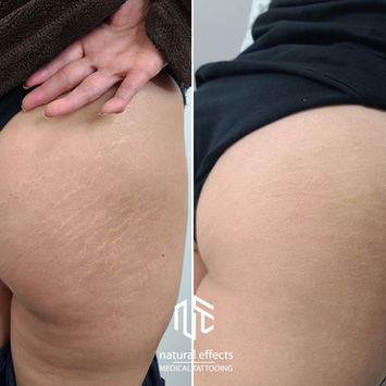 Stretchmarks Camouflage on butt and hips