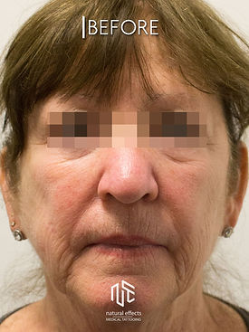 Plasma Non Surgical Full Facelift Skin Tightening
