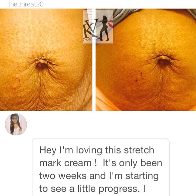 Thumbnail: Stretch Mark Removal