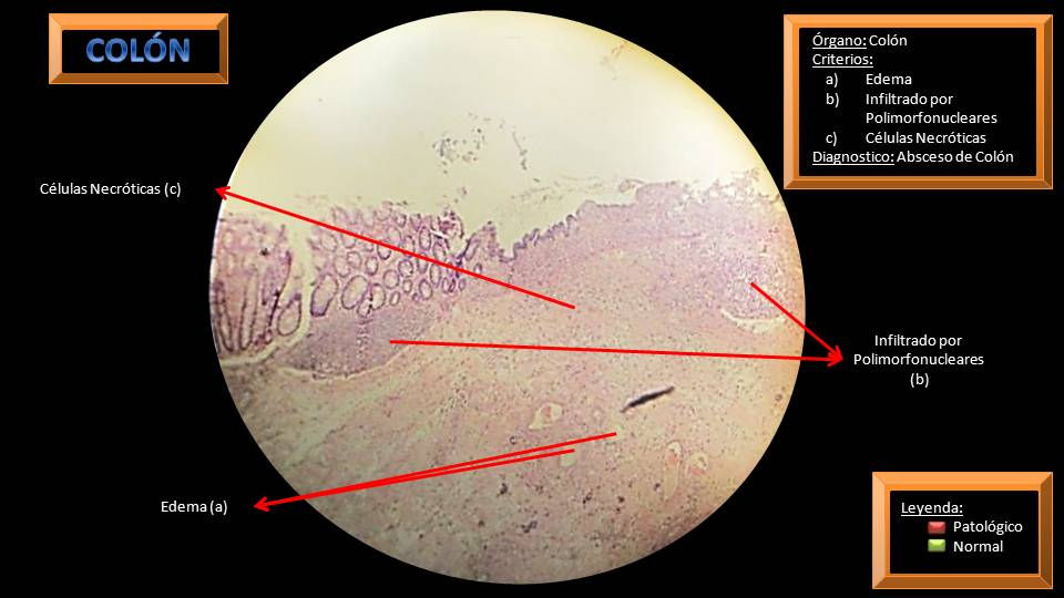 Absceso de Colon.jpg