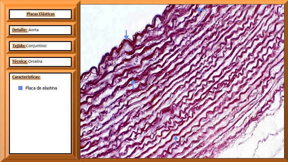 placas elasticas.jpg