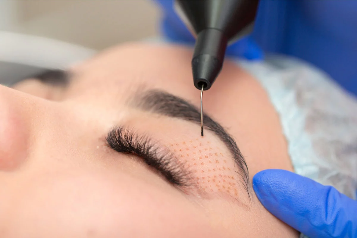 Fibroblast-Plasma-treatment-for-non-surgical-eyelid-lift.jpg.webp