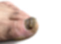 fungal nail two.jpg
