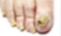 fungal nail one.jpg