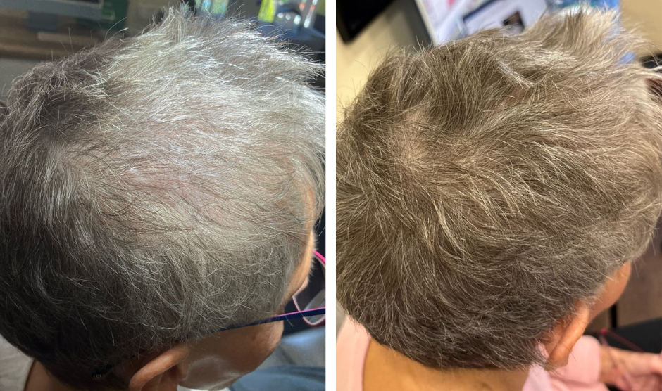 Calecim® Advanced Hair Restoration in Worcestershire