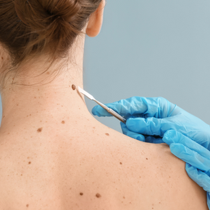 Skin Cancer: Why Early Intervention Matters