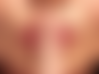 Lip Fillers In Midlife? Choose Subtle Not Full